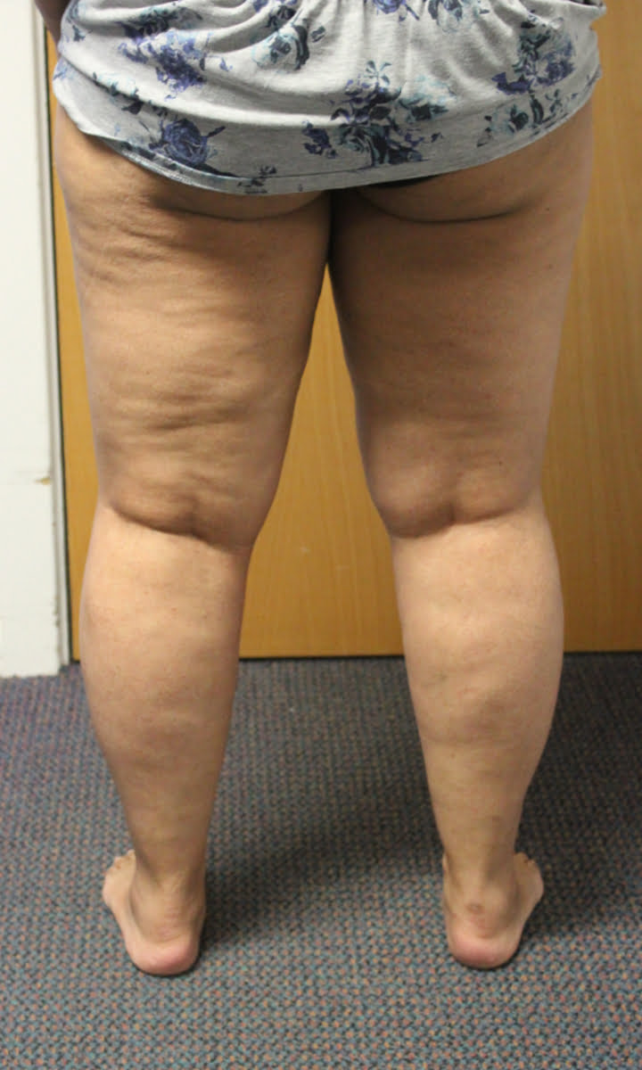 Lower limb lipoedema liposuction before surgery posterior view