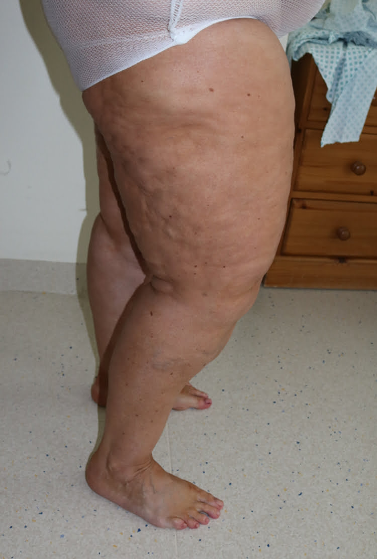 Lower limb lipoedema liposuction before surgery right lateral 2