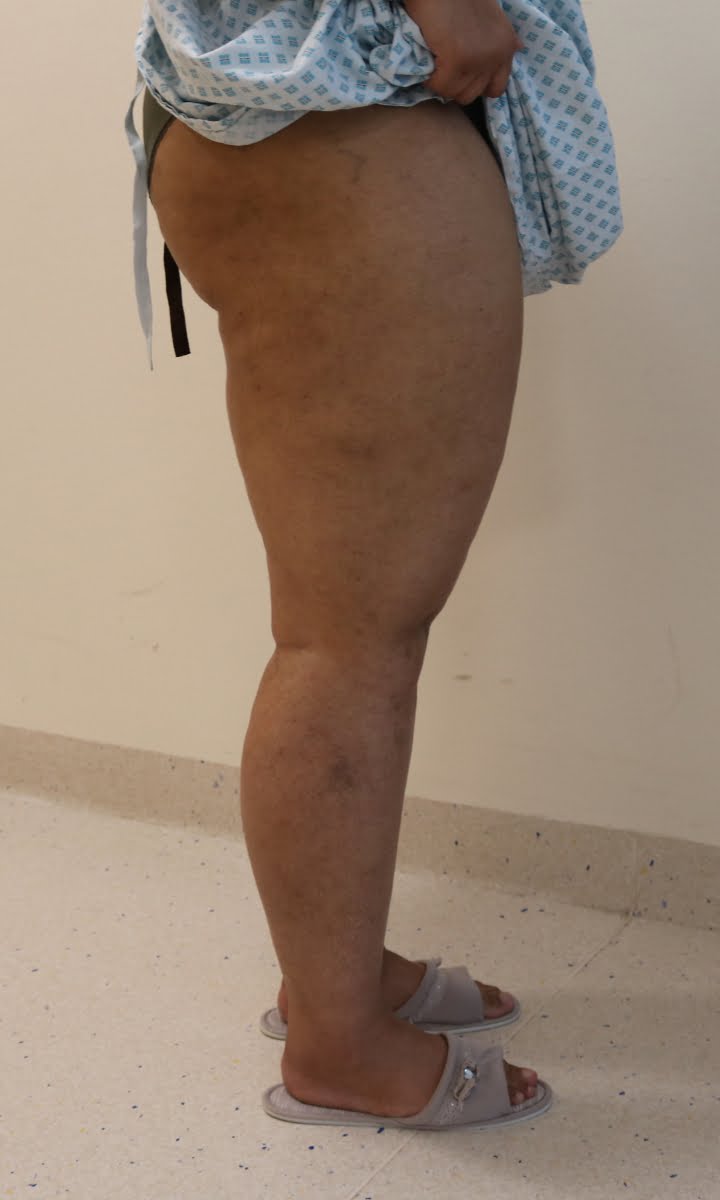 Lower limb lipoedema liposuction before surgery right lateral