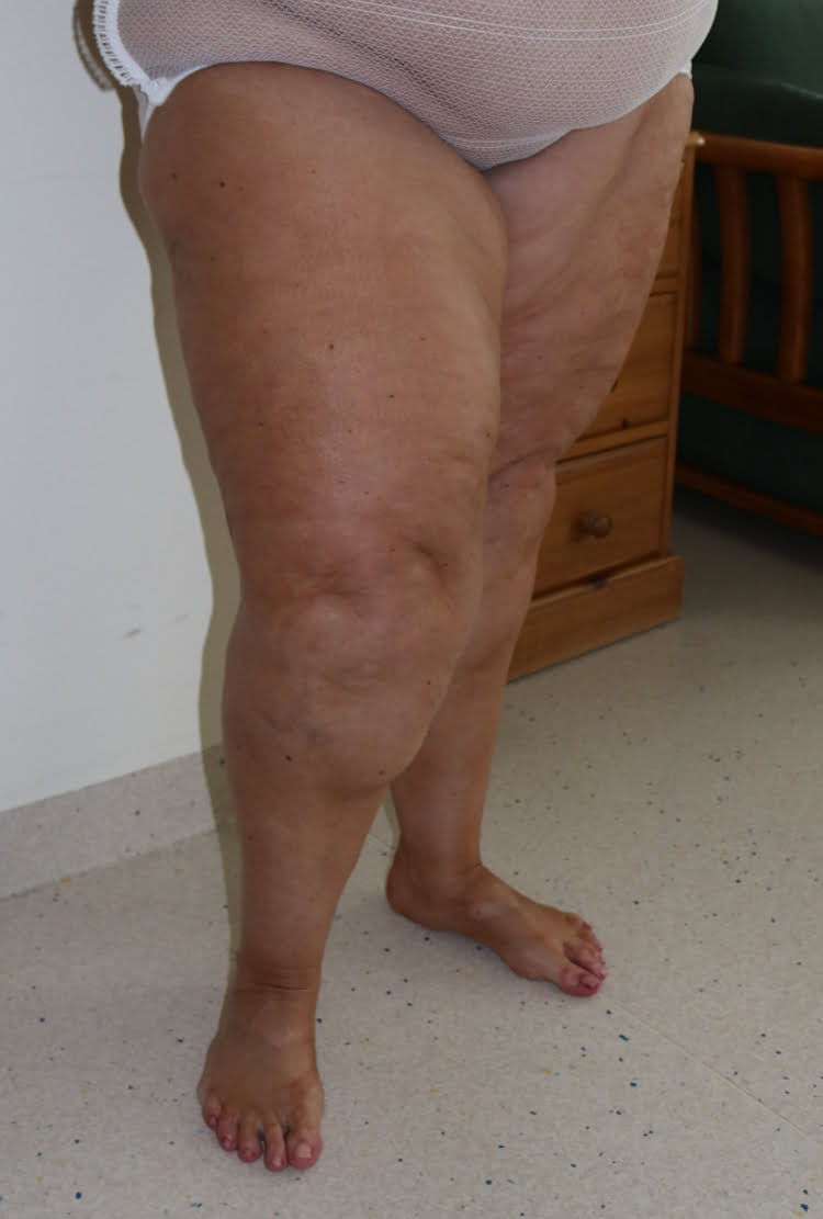 Lower limb lipoedema liposuction before surgery right oblique 2