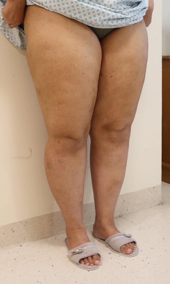Lower limb lipoedema liposuction before surgery right oblique