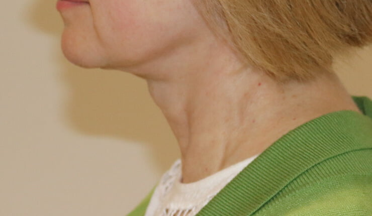 Neck lift after left lateral