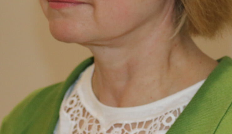 Neck lift after left oblique