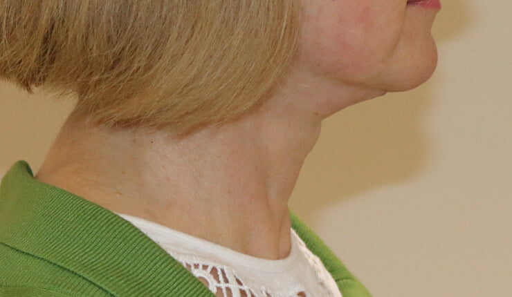 Neck lift after right lateral