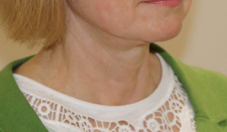 Neck lift after right oblique