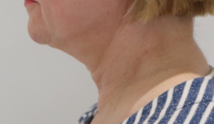 Neck lift before left lateral