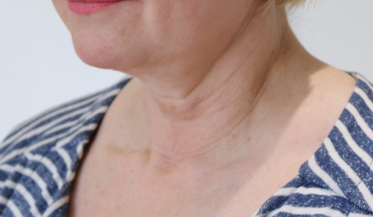 Neck lift before left oblique
