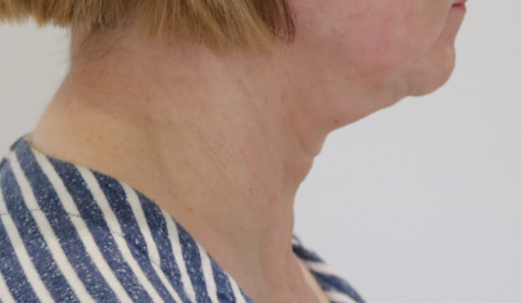 Neck lift before right lateral