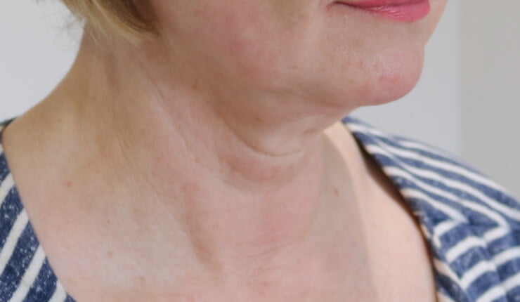 Neck lift before right oblique