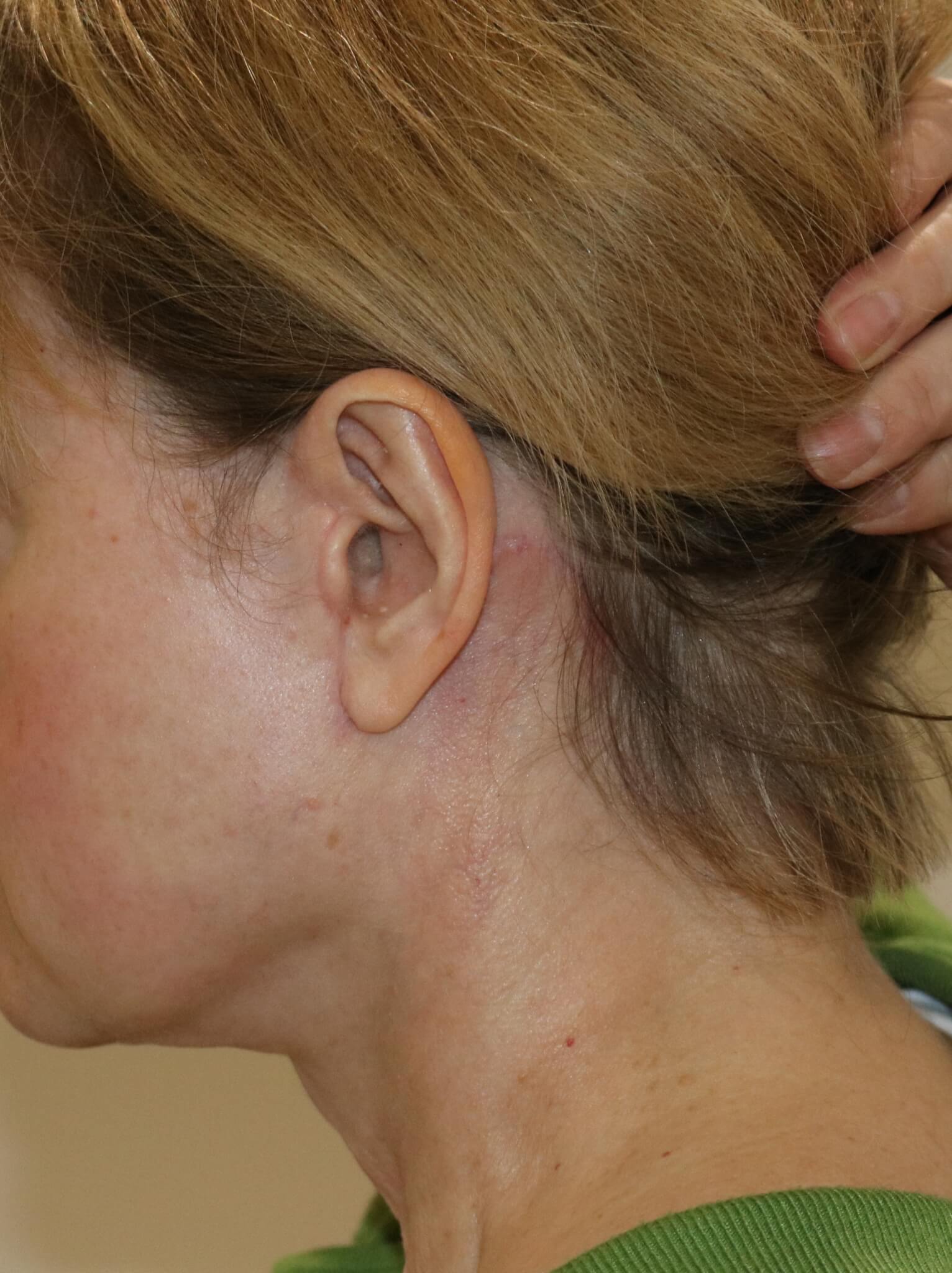 Neck lift scar