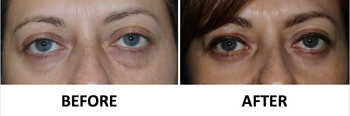 Transconjunctival lower blepharoplasty and TCA peel AP view