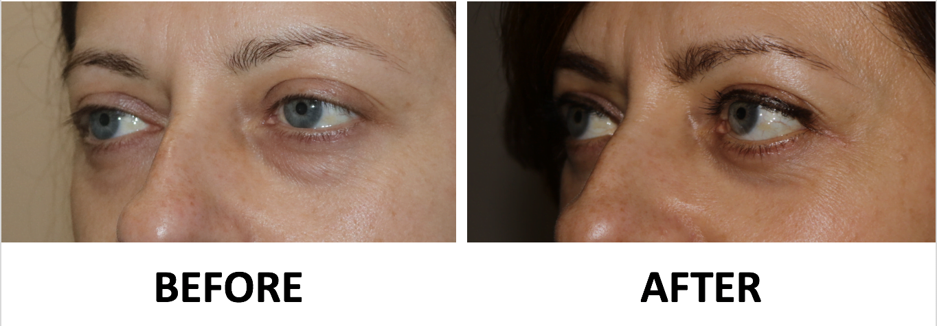 Transconjunctival lower blepharoplasty and TCA peel left oblique view