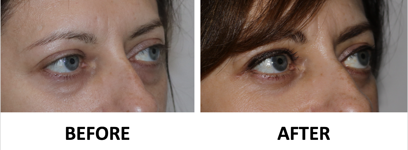 Transconjunctival lower blepharoplasty and TCA peel right oblique view