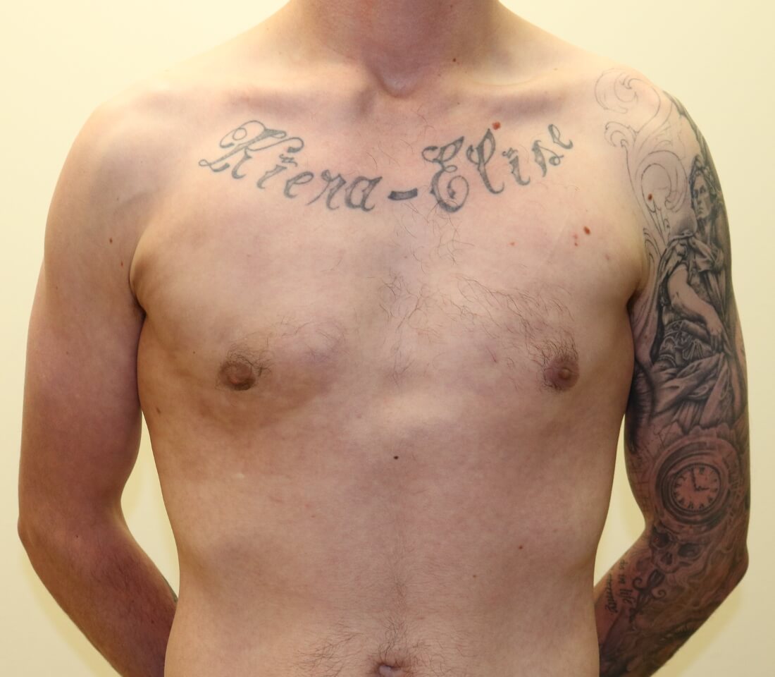 Gynaecomastia surgery AP view post surgery