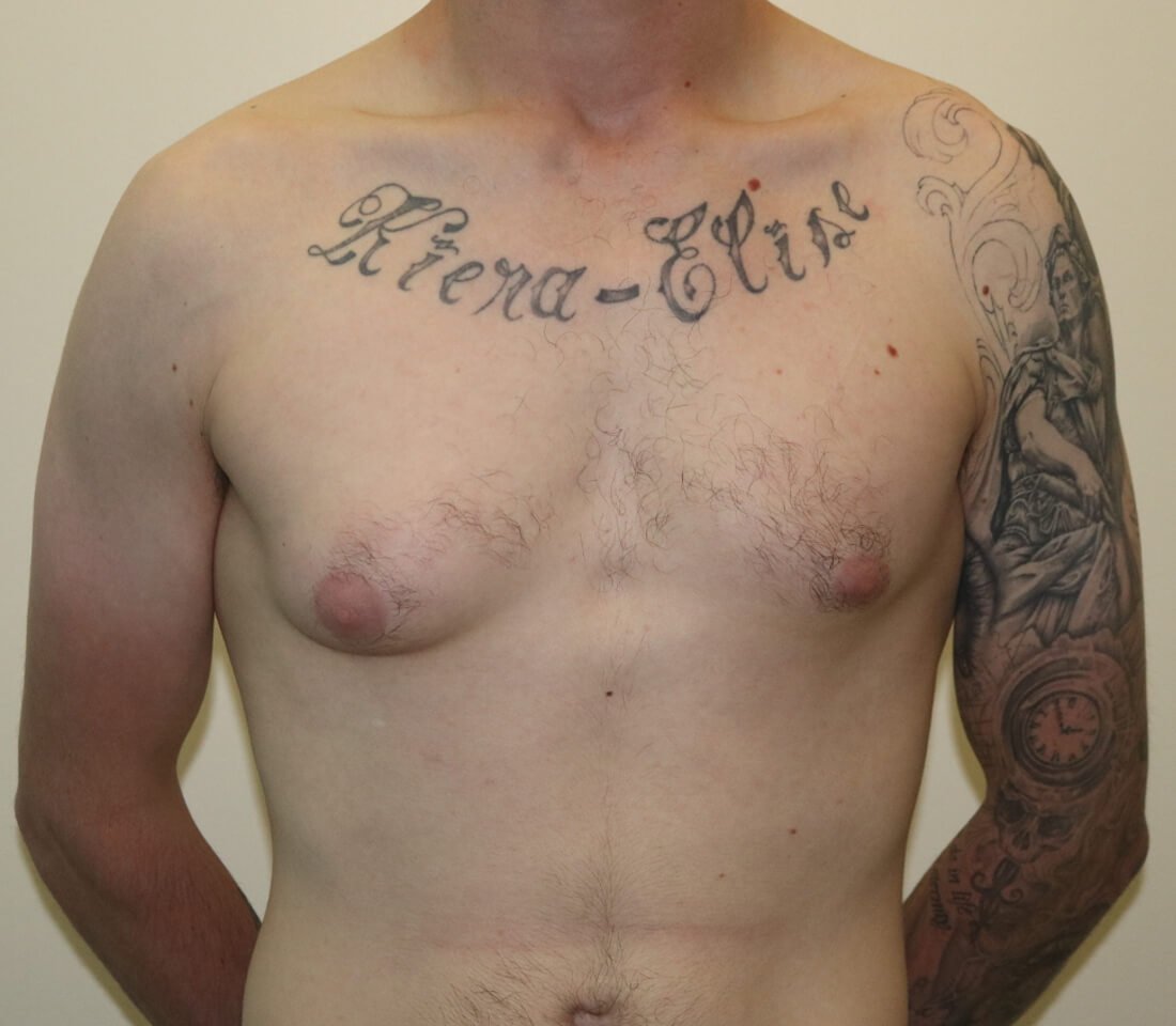 Gynaecomastia surgery AP view pre surgery