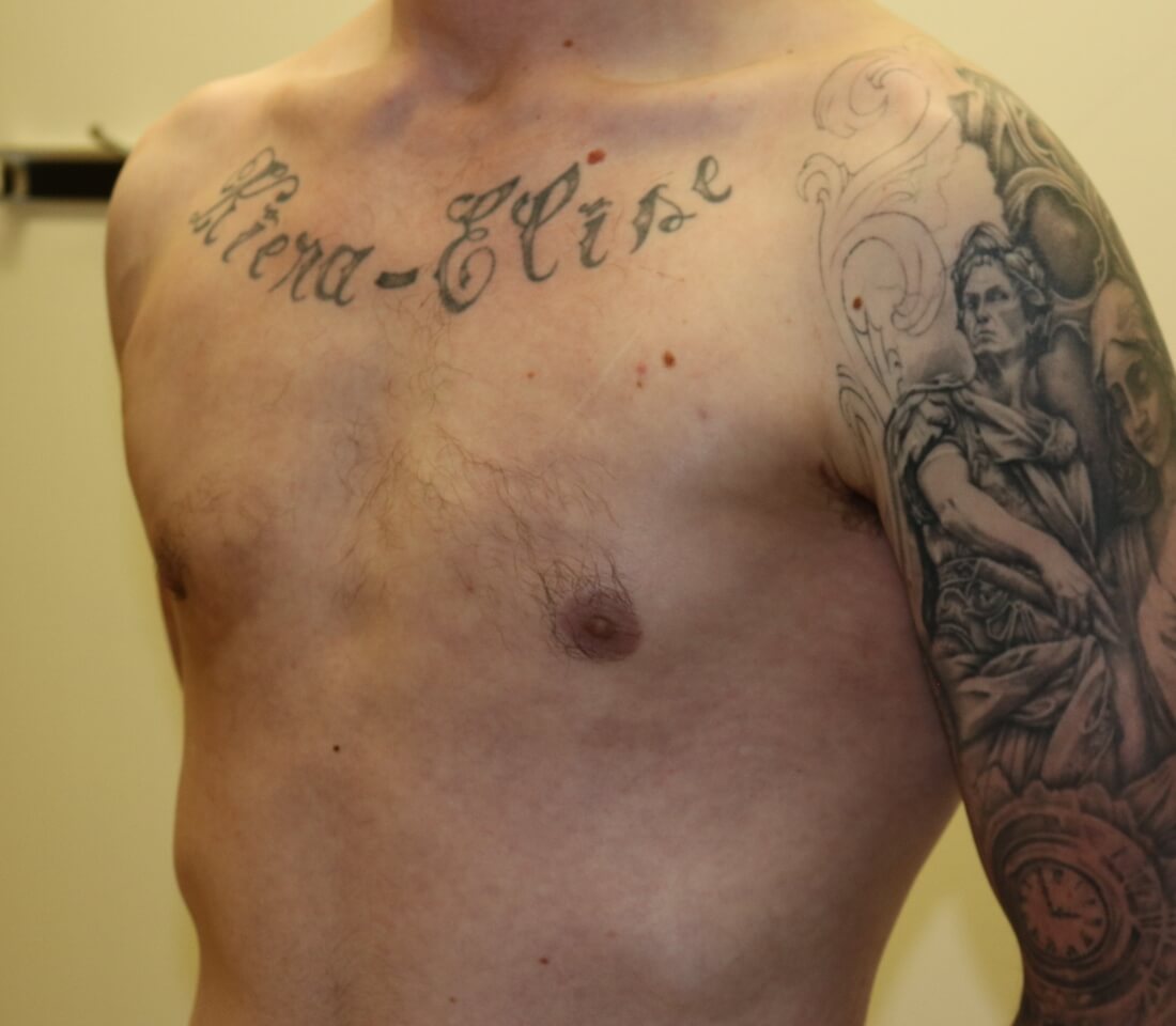 Gynaecomastia surgery left oblique post surgery