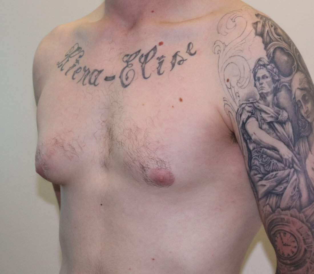 Gynaecomastia surgery left oblique pre surgery