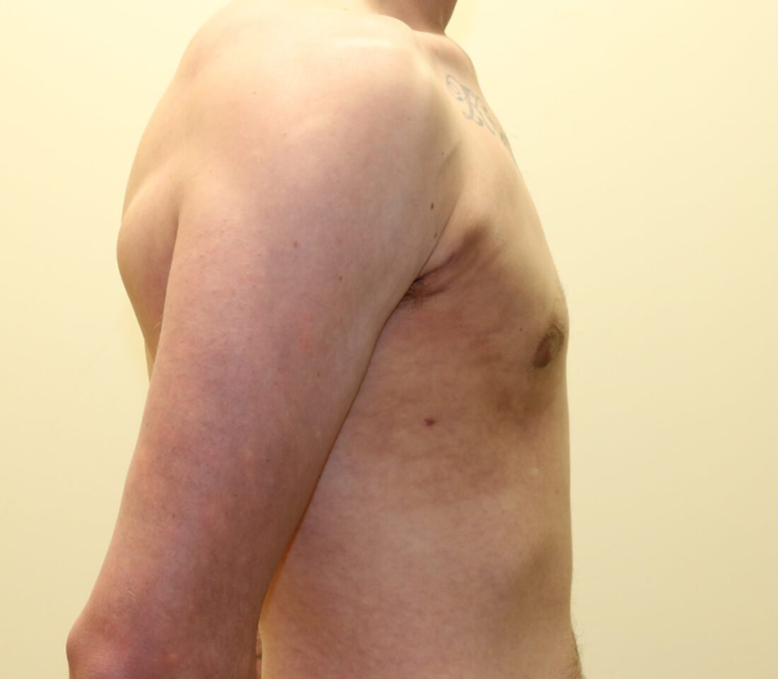 Gynaecomastia surgery right lateral post surgery