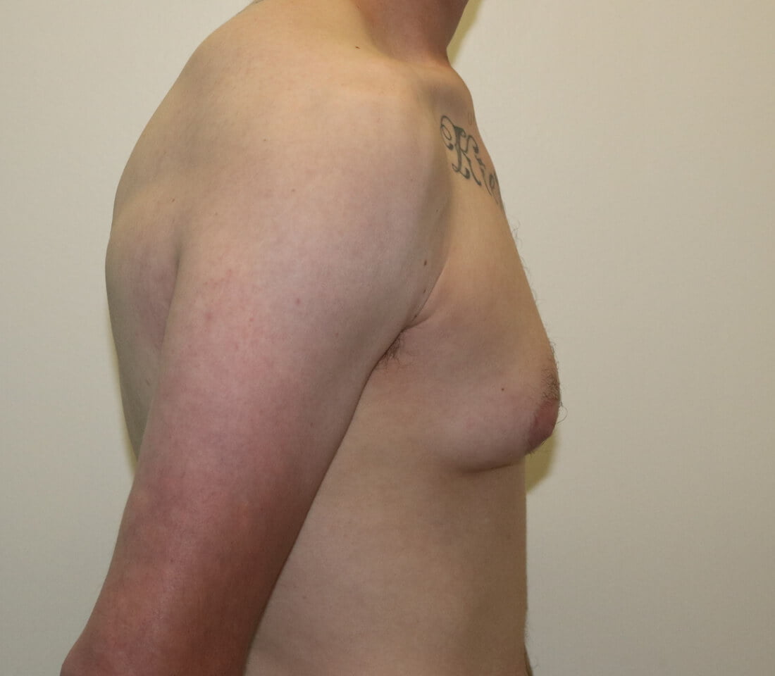 Gynaecomastia surgery right lateral pre surgery