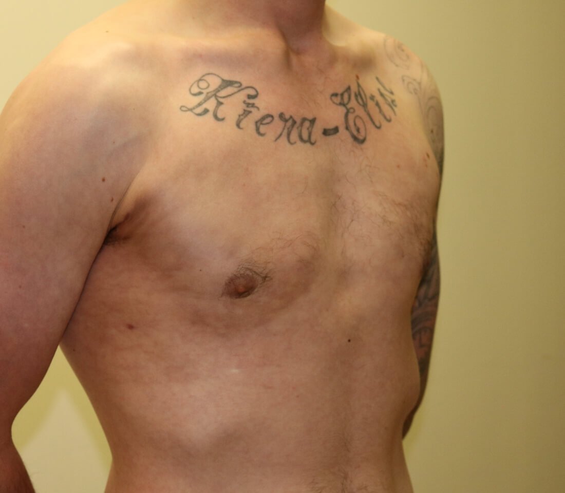 Gynaecomastia surgery right oblique post surgery
