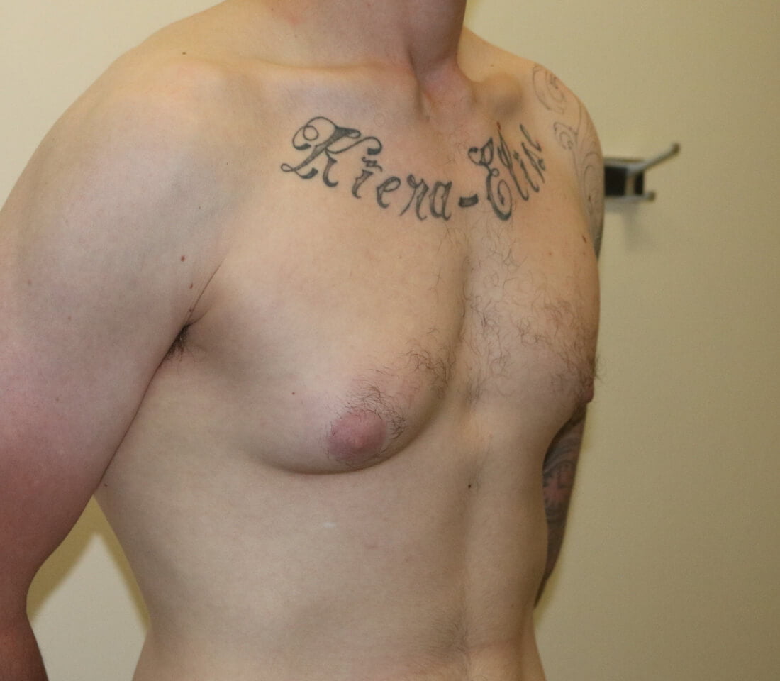 Gynaecomastia surgery right oblique pre surgery