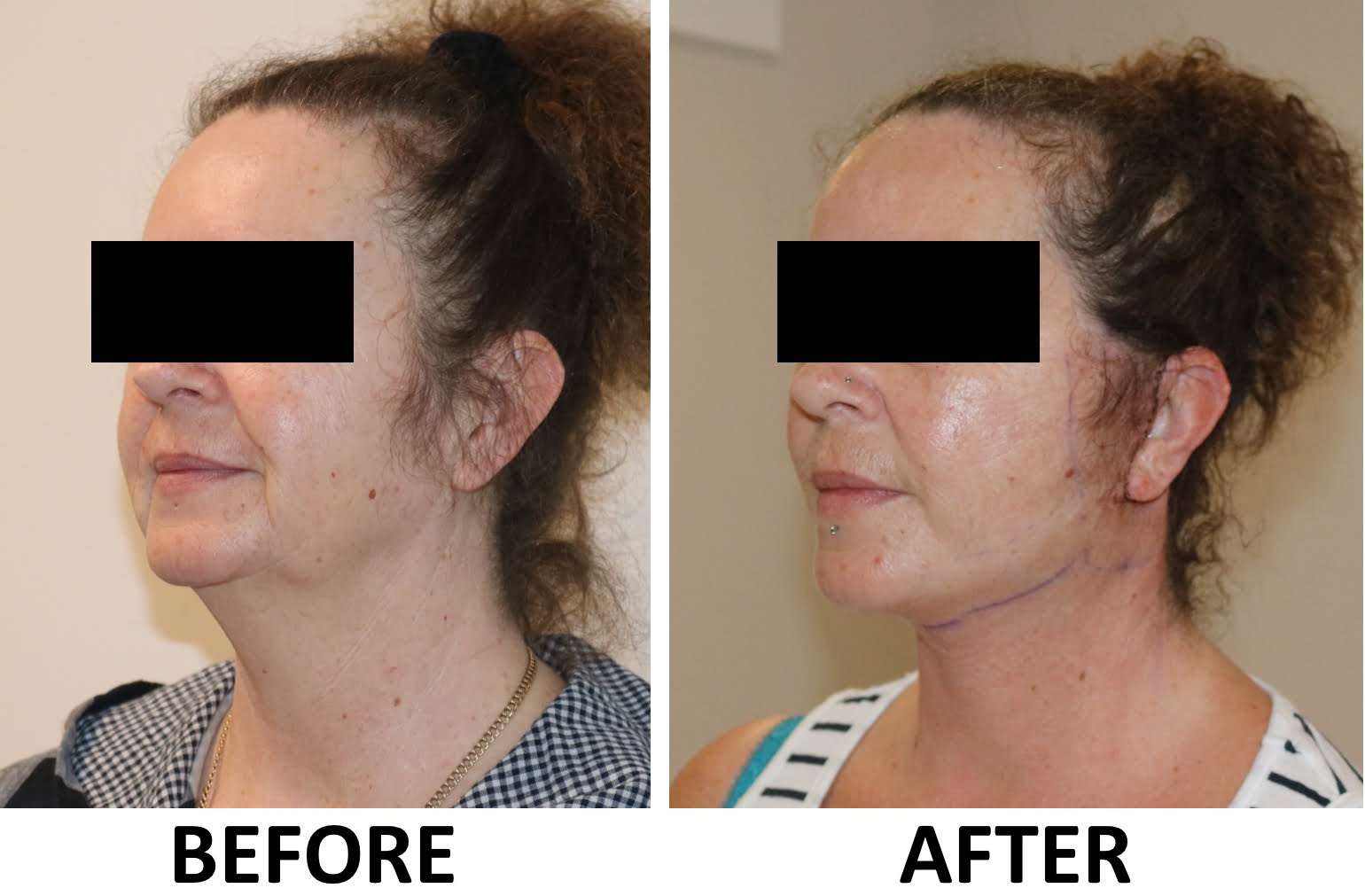 Facelift necklift