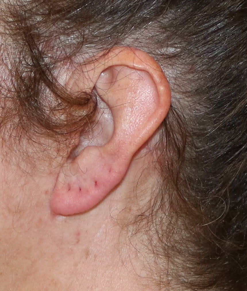 Facelift scar at 6 months