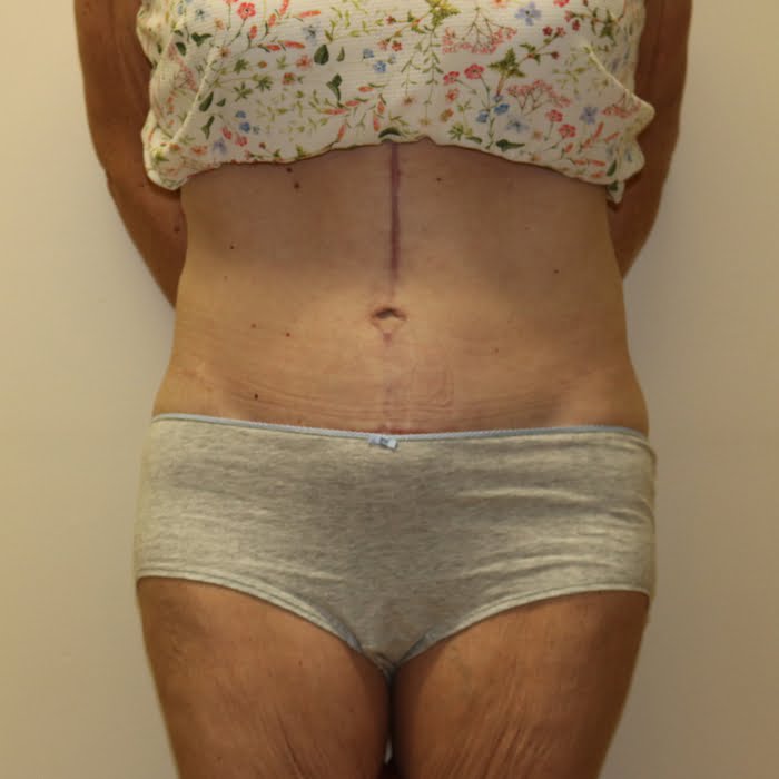 Fleur de lis tummy tuck AP view after surgery