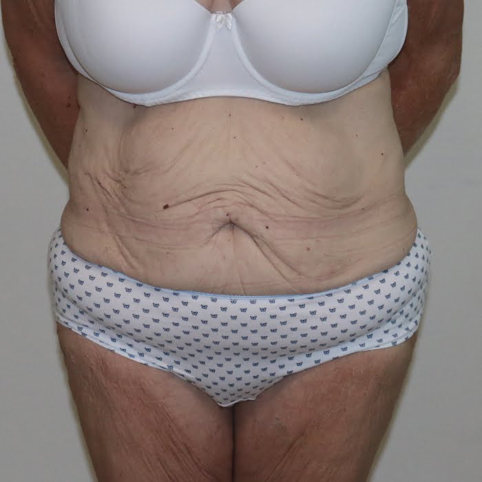 Fleur de lis tummy tuck AP view before surgery