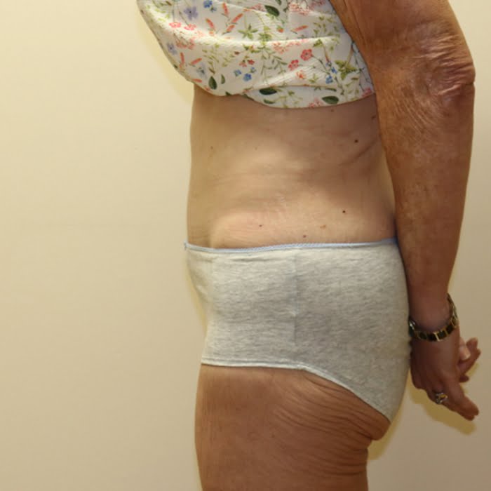 Fleur de lis tummy tuck left lateral view after surgery