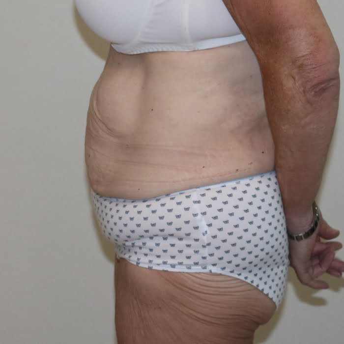 Fleur de lis tummy tuck left lateral view before surgery