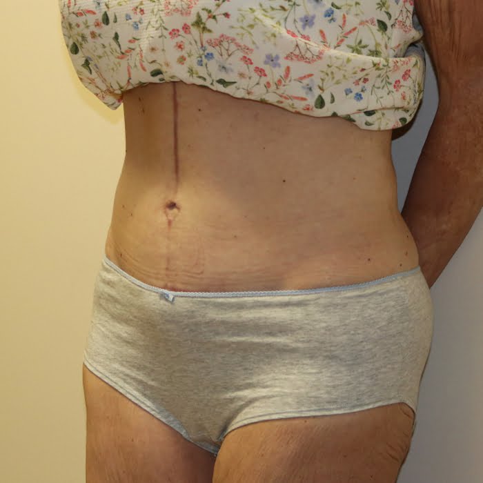 Fleur de lis tummy tuck left oblique view after surgery