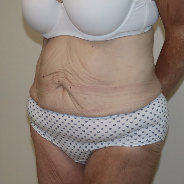 Fleur de lis tummy tuck left oblique view before surgery