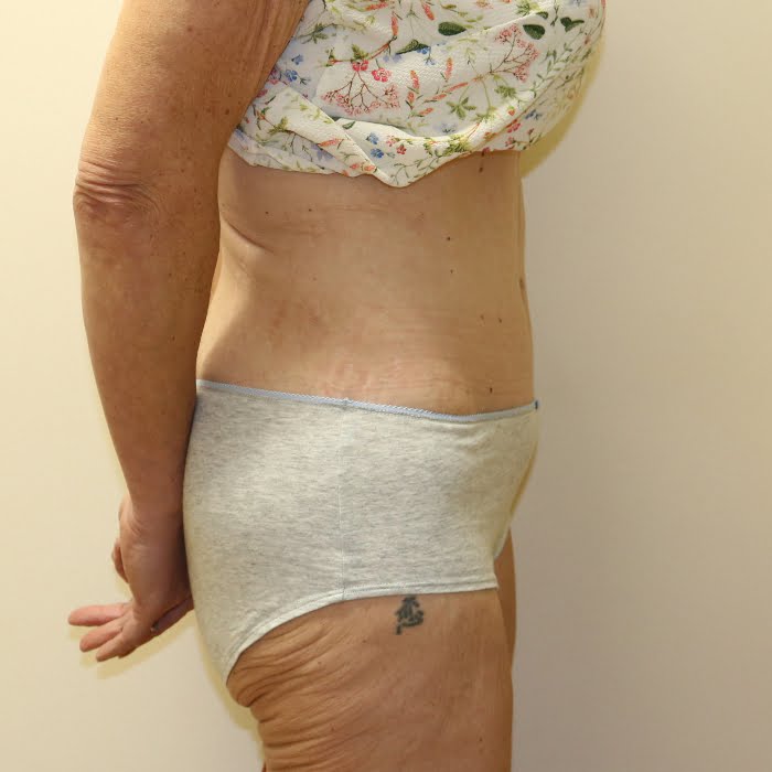 Fleur de lis tummy tuck right lateral view after surgery