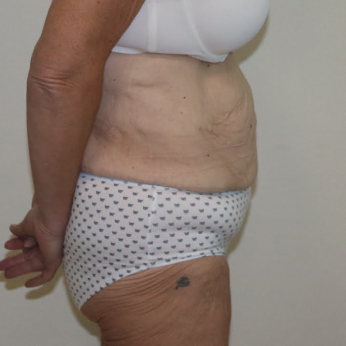 Fleur de lis tummy tuck right lateral view before surgery