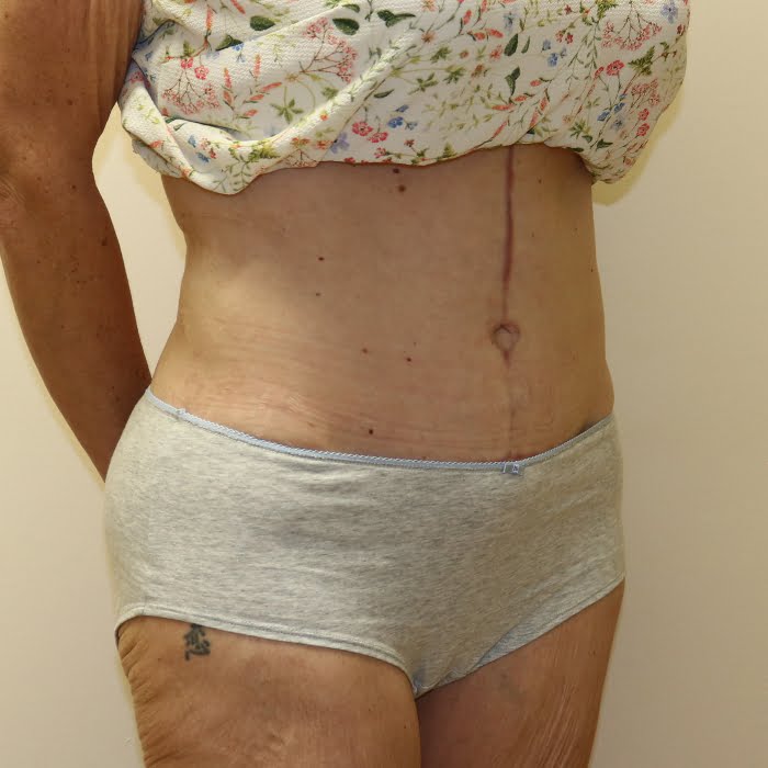 Fleur de lis tummy tuck right oblique view after surgery