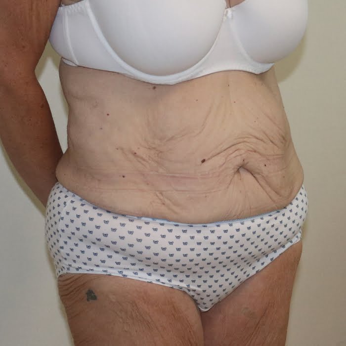 Fleur de lis tummy tuck right oblique view before surgery