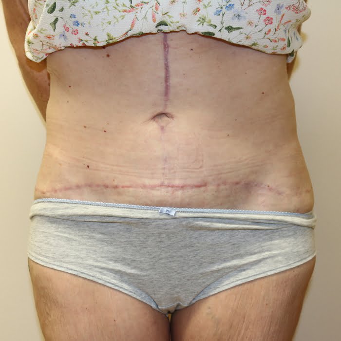 Fleur de lis tummy tuck scar