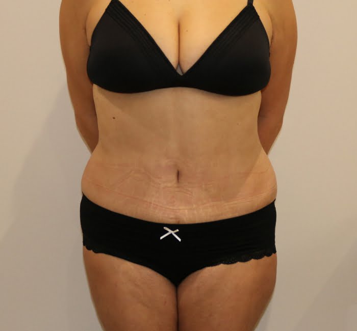 Lipoabdominoplasty after surgery AP view