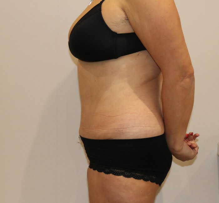Lipoabdominoplasty after surgery left lateral view