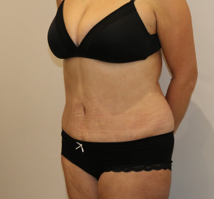 Lipoabdominoplasty after surgery left oblique view