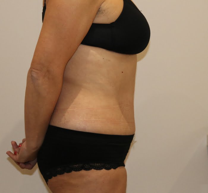 Lipoabdominoplasty after surgery right lateral view