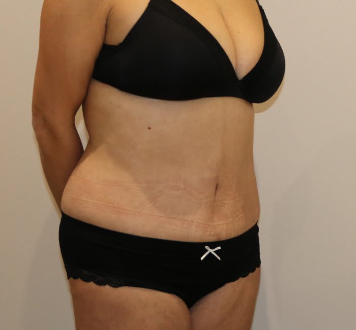 Lipoabdominoplasty after surgery right oblique view