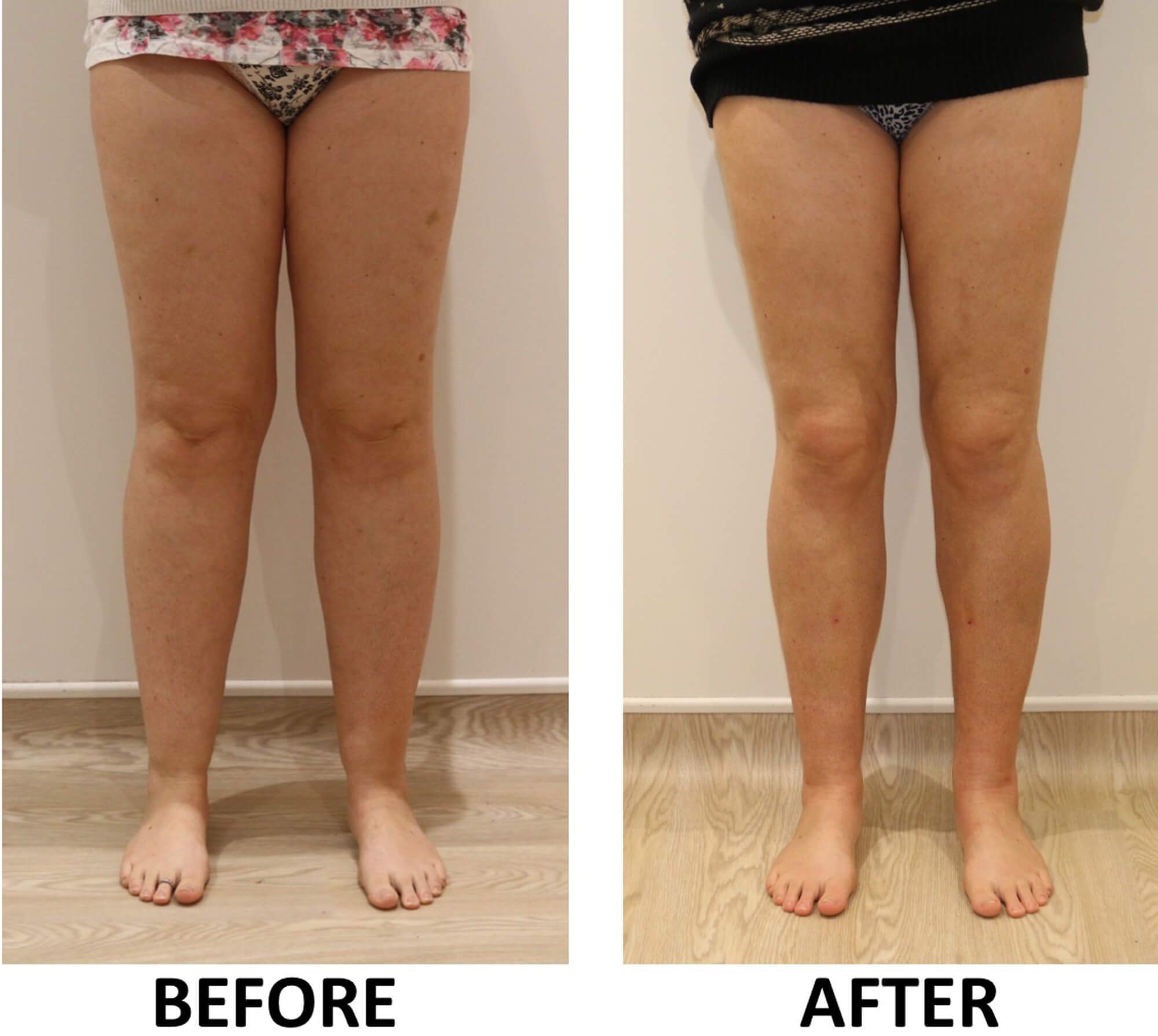 Lower limb liposculpture AP view 1