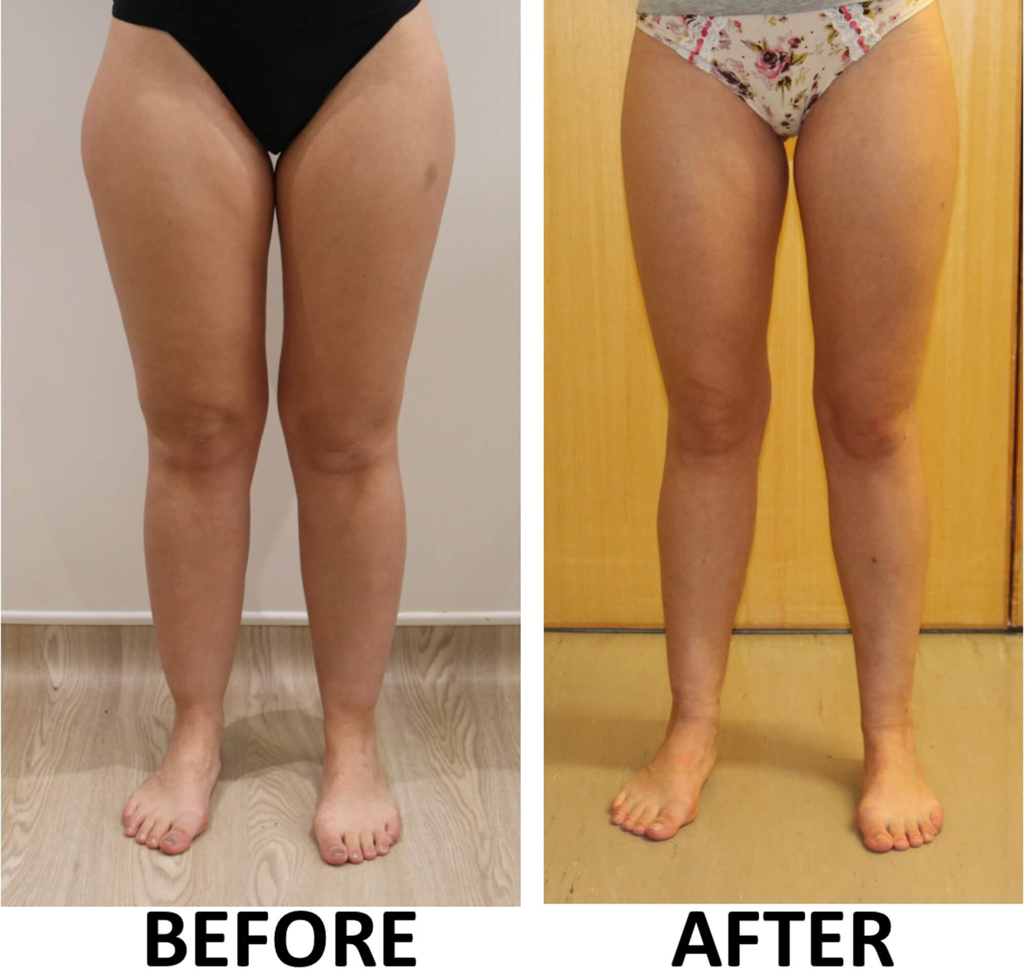 Lower limb liposculpture AP view 2