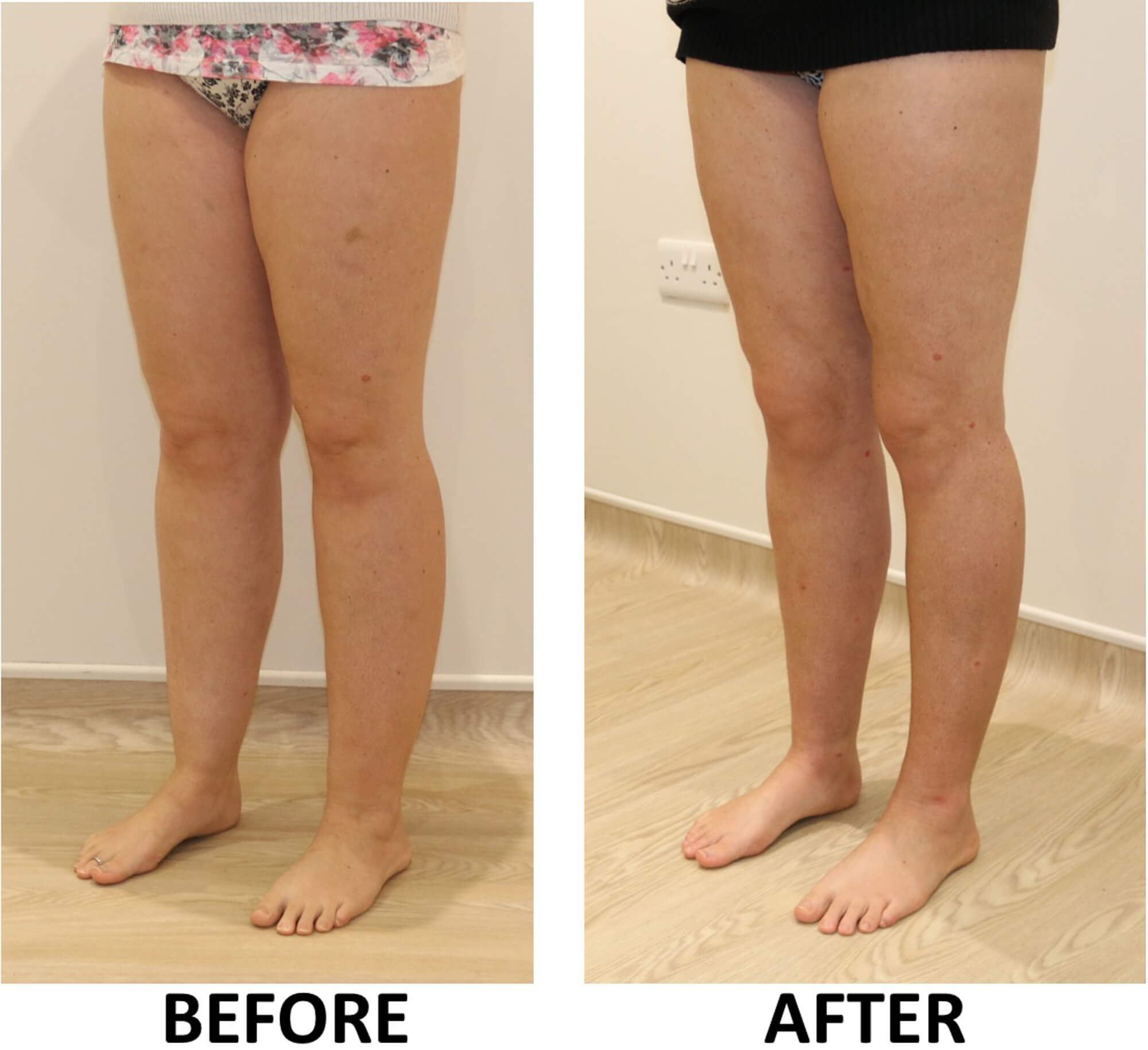 Lower limb liposculpture left oblique view 1