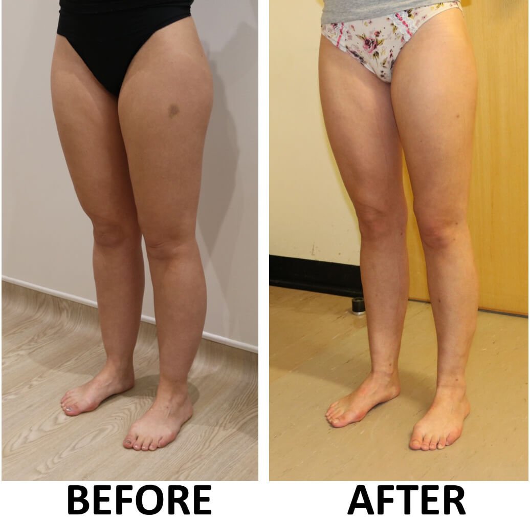 Lower limb liposculpture left oblique view 2