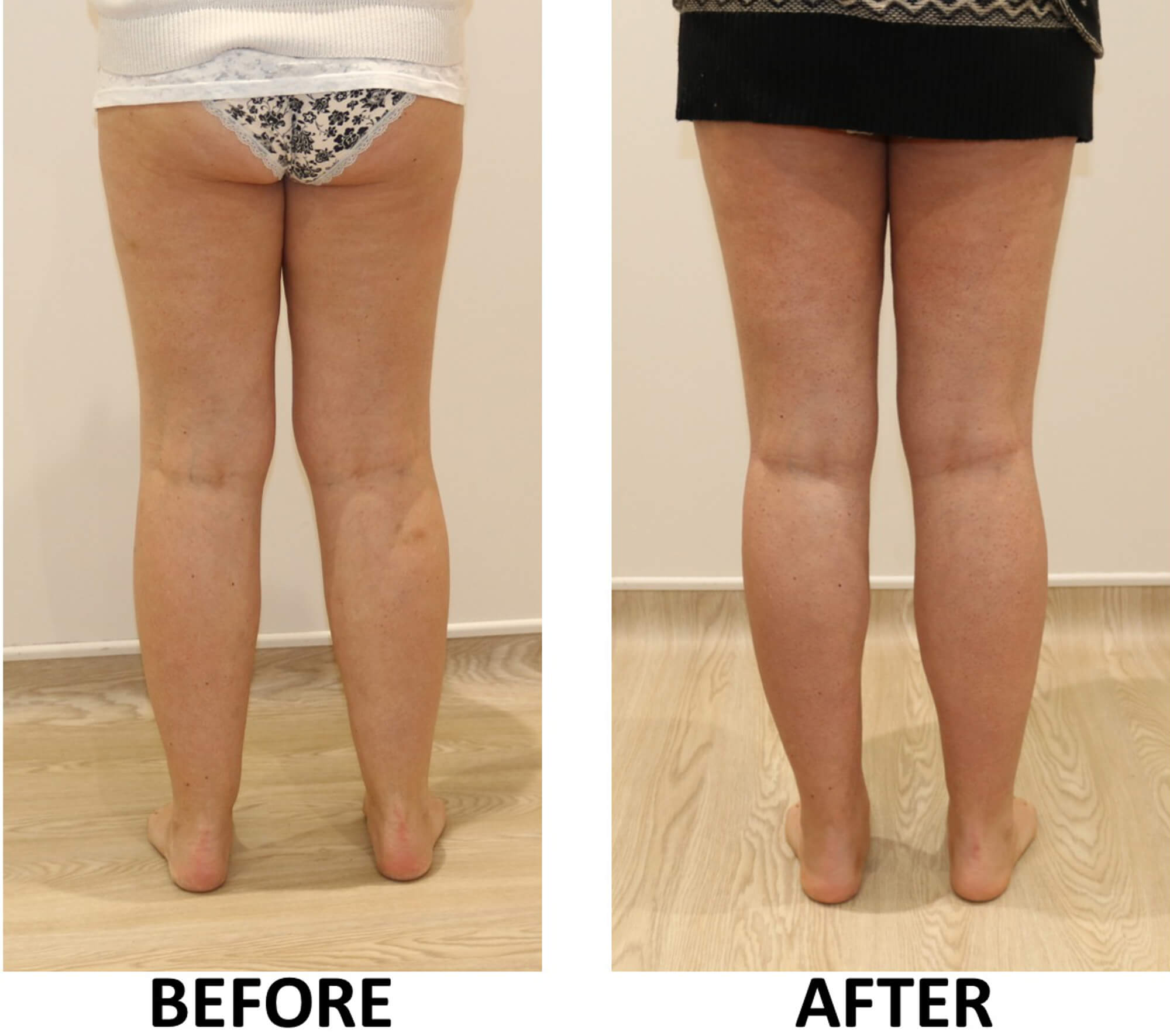 Lower limb liposculpture posterior view 1