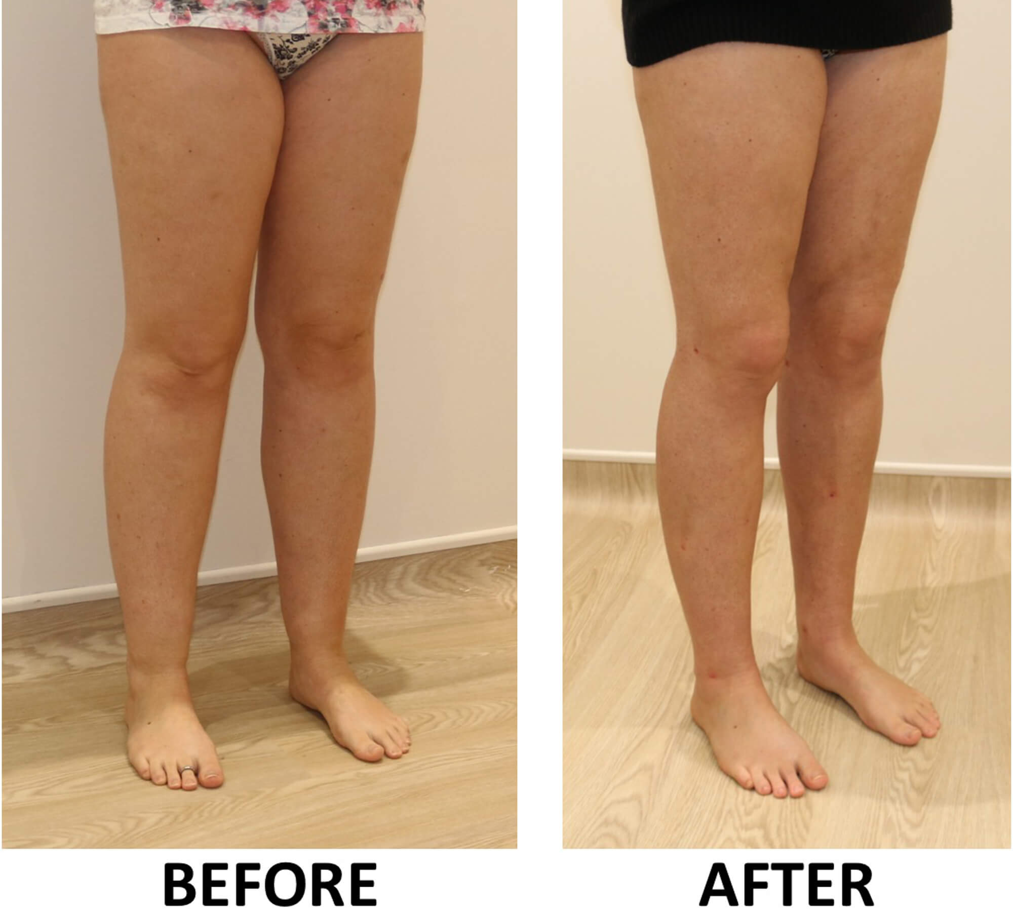 Lower limb liposculpture right oblique view 1
