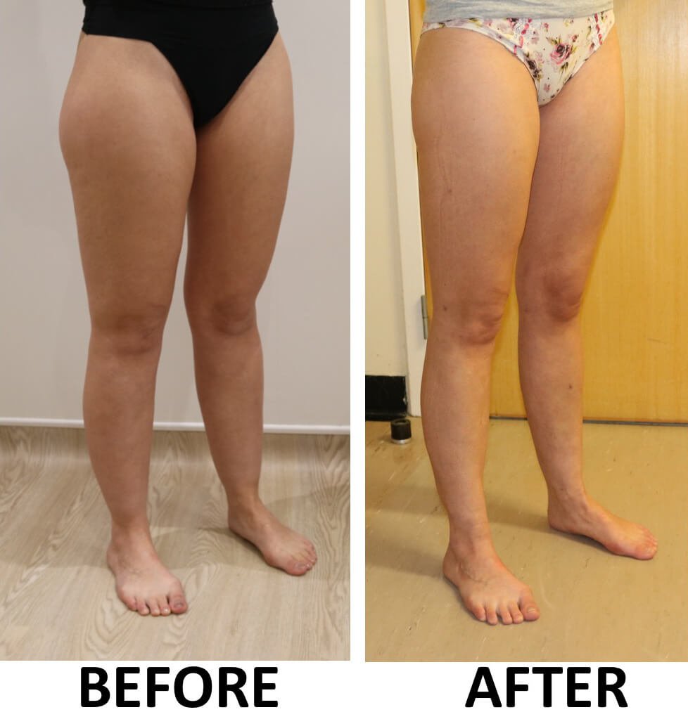 Lower limb liposculpture right oblique view 2
